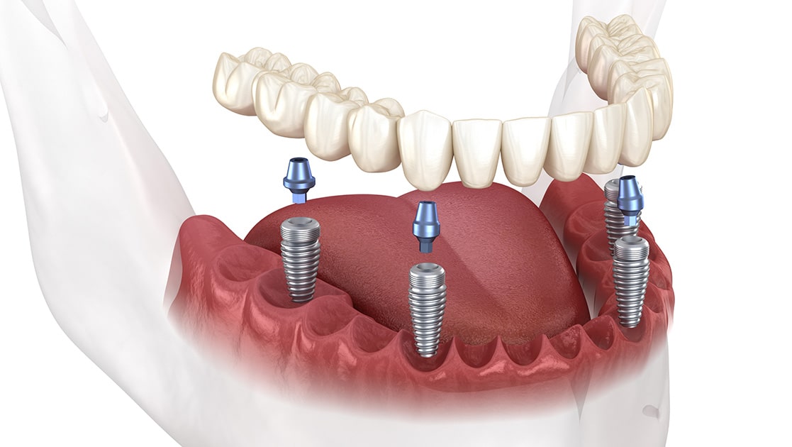 Implant-Supported Bridge