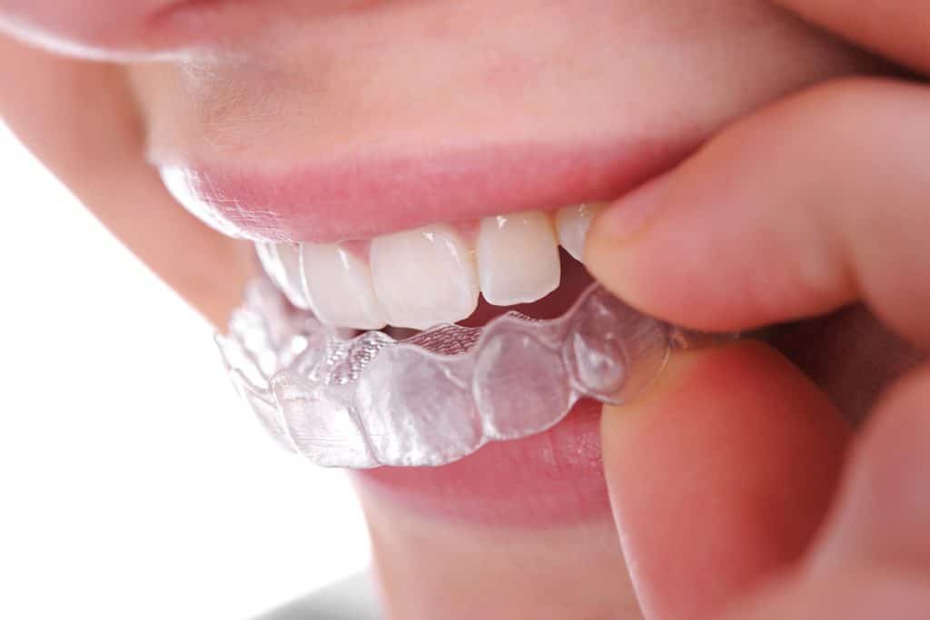 Clear Aligners vs. Braces: A Guide for Adults in Mundelein, IL