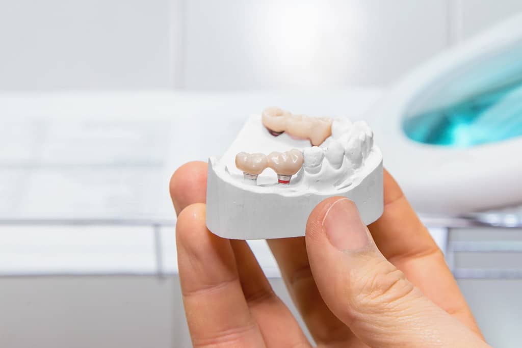 Dental crowns