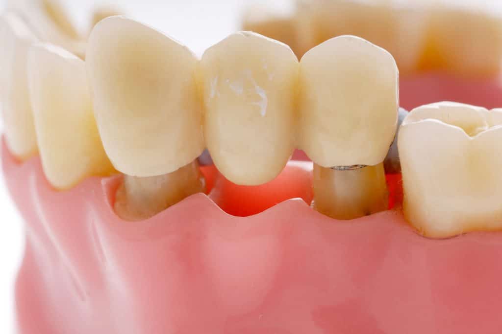 How Long Do Dental Bridges Last? Advice from a Vernon Hills, IL Dentist