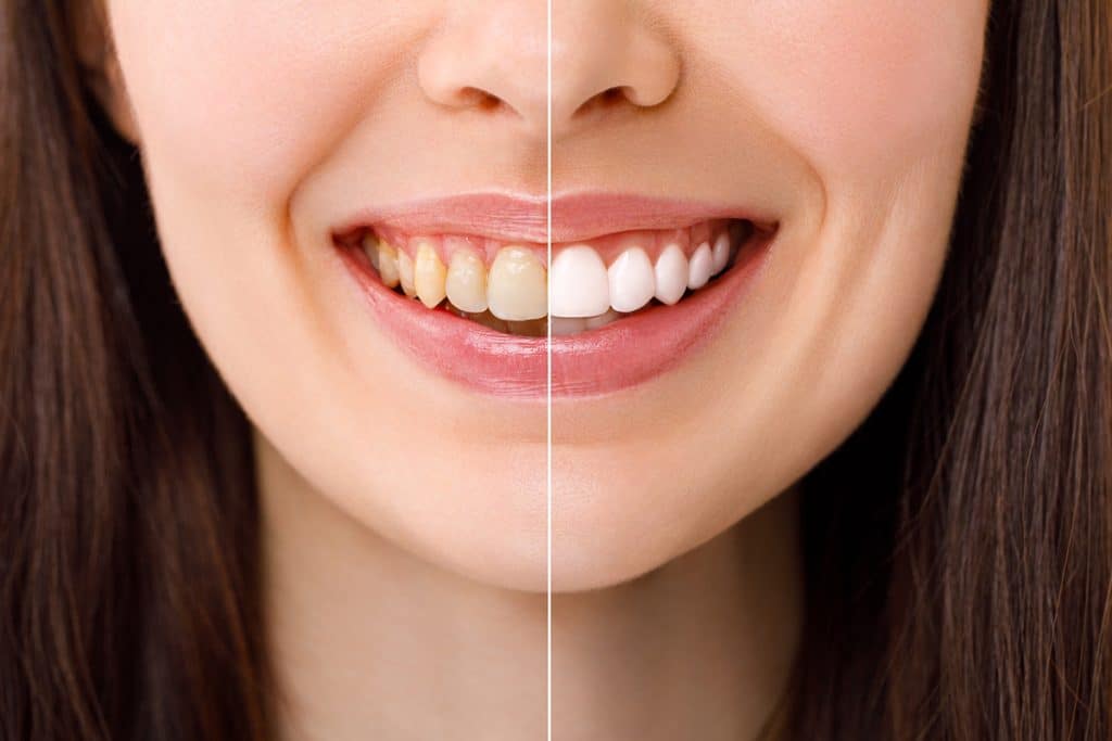 In-Office Whitening vs. At-Home Kits: What Works Best in Vernon Hills, IL?