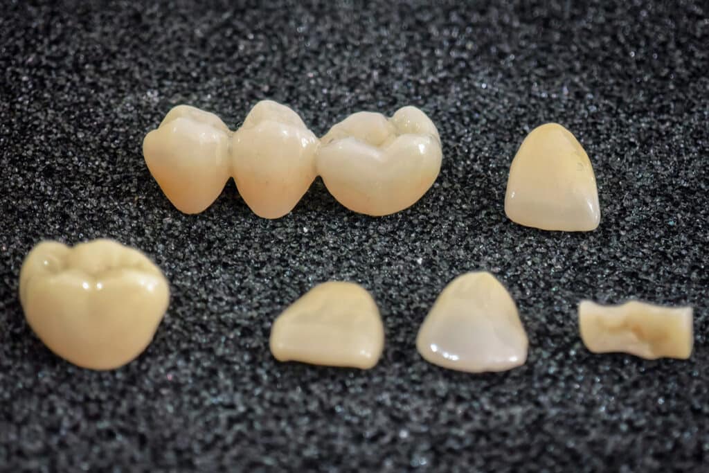 Top Signs You May Need a Dental Bridge in Libertyville, IL
