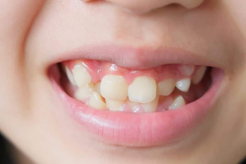 What Happens If You Don’t Correct Crooked Teeth? Advice from a Mundelein, IL Orthodontist