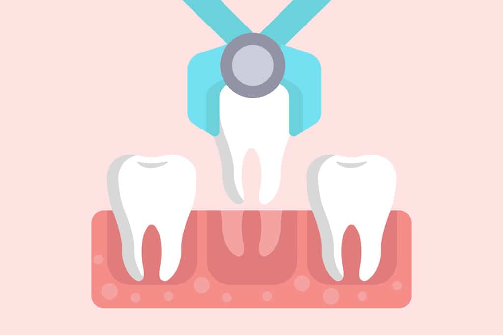 What Not to Do After a Tooth Extraction in Vernon Hills, IL