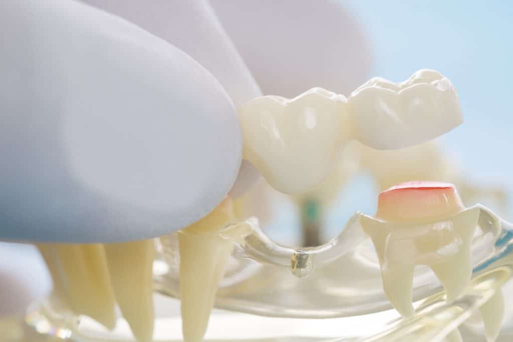 What to Expect from Dental Bridges in Libertyville, IL